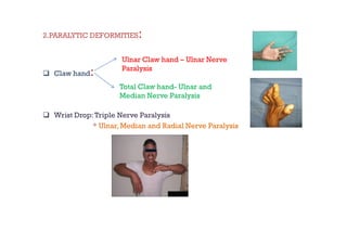 Physiotherapy in Leprosy and management of deformities | PDF