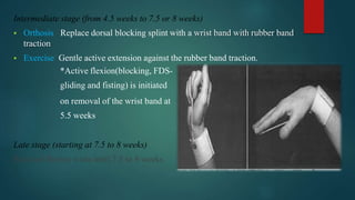 Intermediate stage (from 4.5 weeks to 7.5 or 8 weeks)
 Orthosis : Replace dorsal blocking splint with a wrist band with rubber band
traction.
 Exercise :Gentle active extension against the rubber band traction.
*Active flexion(blocking, FDS-
gliding and fisting) is initiated
on removal of the wrist band at
5.5 weeks.
Late stage (starting at 7.5 to 8 weeks)
Resisted flexion waits until 7.5 to 8 weeks.
 