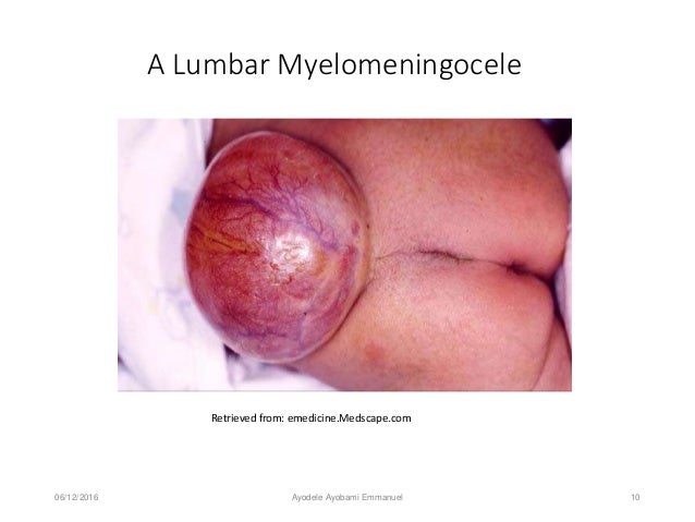 physiotherapy management of hydrocephalus pdf