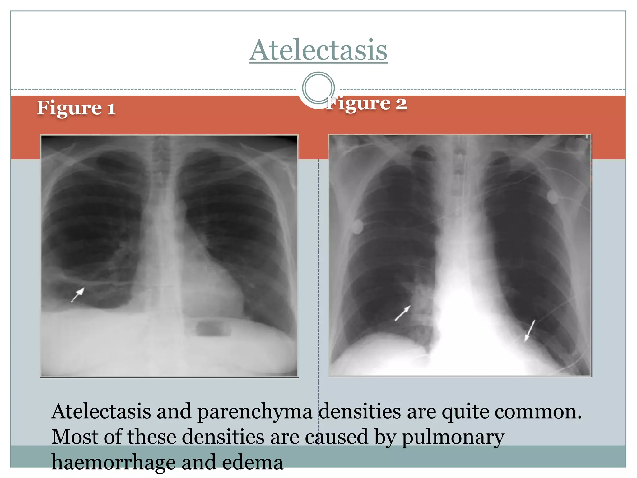 Rehabilitation of patient with pleural effusion | PDF