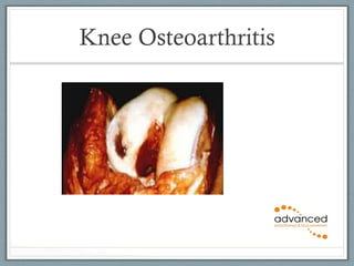 Knee Osteoarthritis 
 