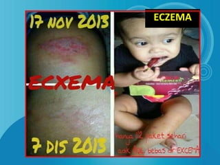 ECZEMA
 