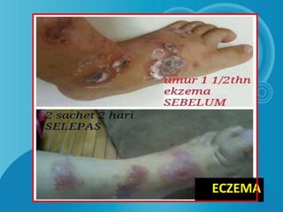 ECZEMA
 