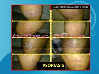 PSORIASIS
SUFFERED PSORIASIS FOR 5 YEARS
 