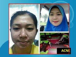 ACNE
 