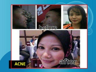 ACNE
 