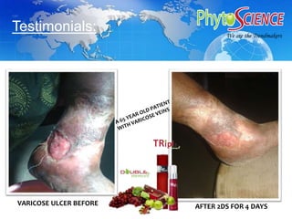 VARICOSE ULCER BEFORE AFTER 2DS FOR 4 DAYS
We are the TrendmakerWe are the Trendmakers
Testimonials:
 