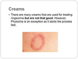 Creams
There are many creams that are used for treating
ringworms but are not that good. However,
Phytozine is an exception as it starts the process
fast.