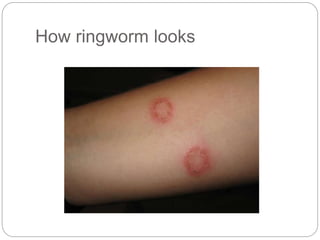 How ringworm looks