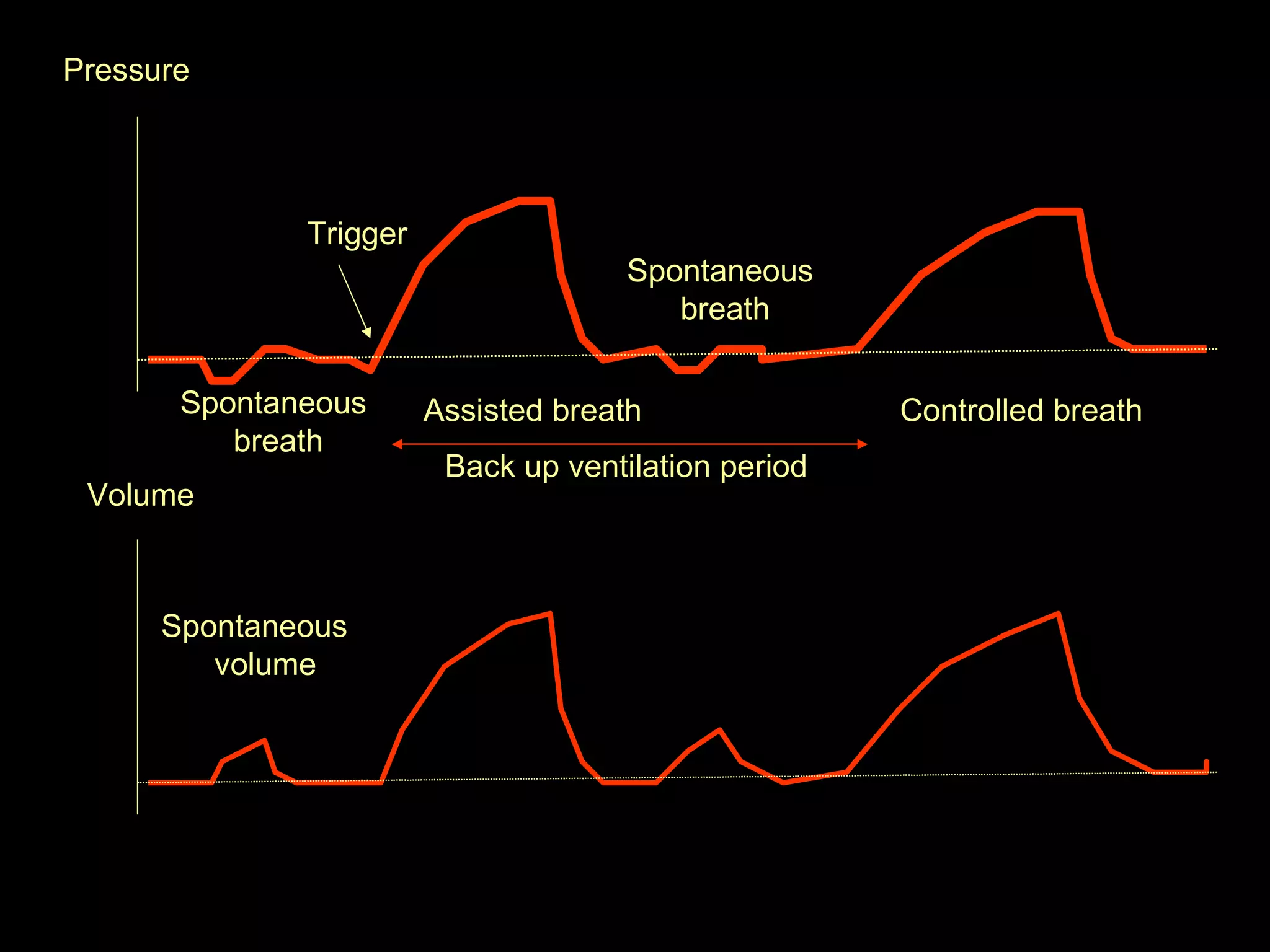 Spontaneous breath Assisted breath Back up ventilation period Controlled breath Spontaneous volume Trigger  Spontaneous breath Pressure  Volume  