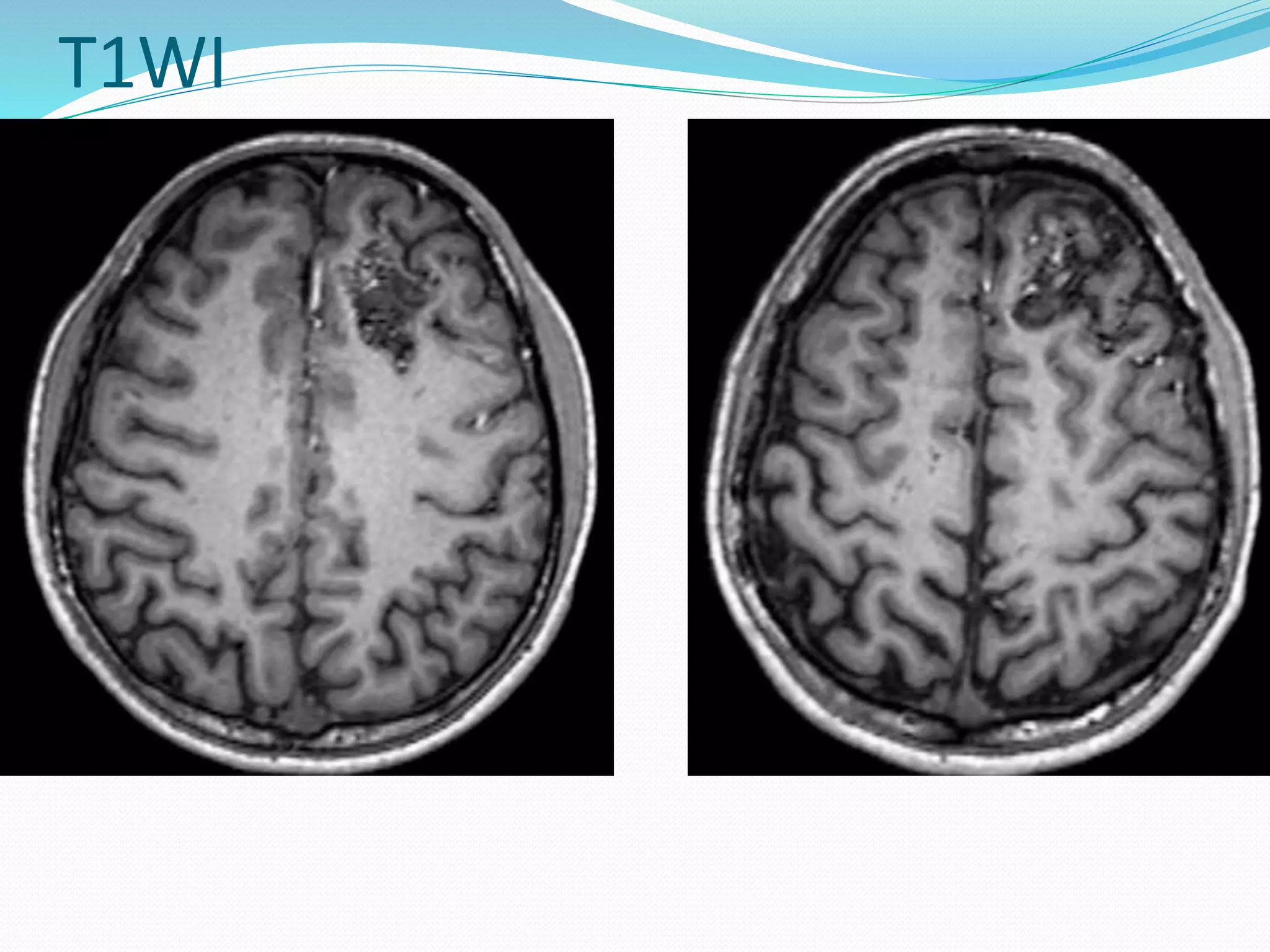 Cerebral/Pial Arteriovenous Malformation (AVM) | PPTX