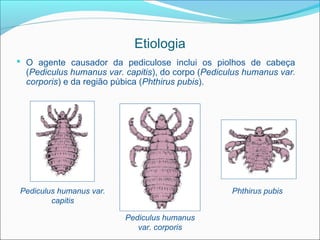 Etiologia
 O agente causador da pediculose inclui os piolhos de cabeça
  (Pediculus humanus var. capitis), do corpo (Pediculus humanus var.
  corporis) e da região púbica (Phthirus pubis).




Pediculus humanus var.                              Phthirus pubis
        capitis

                          Pediculus humanus
                             var. corporis
 
