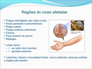 Regiões do corpo afetadas

 Pregas interdigitais das mãos e pés.
 Áreas perianais e periumbilicais.
 Prega cubital.
 Pregas axilares anteriores.
 Cintura.
 Face anterior do punho.
 Nádegas.

 Lesão típica:
  - ♀ - ao redor dos mamilos;
  - ♂ - genitais externos.

 Lactentes, idosos e imunodeprimidos: couro cabeludo, pescoço,orelhas
e região palo-plantar.
 
