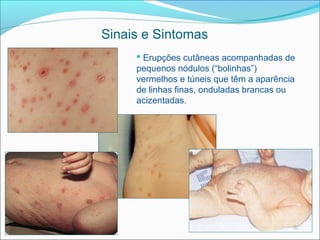 Sinais e Sintomas
      Erupções cutâneas acompanhadas de
     pequenos nódulos (“bolinhas”)
     vermelhos e túneis que têm a aparência
     de linhas finas, onduladas brancas ou
     acizentadas.
 