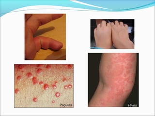 Pápulas   Hives
 