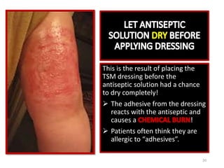 This is the result of placing the
TSM dressing before the
antiseptic solution had a chance
to dry completely!
 The adhesive from the dressing
reacts with the antiseptic and
causes a !
 Patients often think they are
allergic to “adhesives”.
8/11/2017 20
 