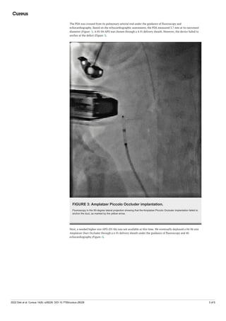 Piccolo Duct Occluder.pdf