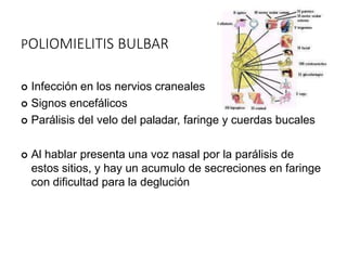 POLIOMIELITIS BULBAR
 Infección en los nervios craneales
 Signos encefálicos
 Parálisis del velo del paladar, faringe y cuerdas bucales
 Al hablar presenta una voz nasal por la parálisis de
estos sitios, y hay un acumulo de secreciones en faringe
con dificultad para la deglución
 
