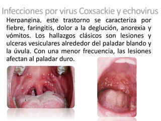 Herpangina, este trastorno se caracteriza por
fiebre, faringitis, dolor a la deglución, anorexia y
vómitos. Los hallazgos clásicos son lesiones y
ulceras vesiculares alrededor del paladar blando y
la úvula. Con una menor frecuencia, las lesiones
afectan al paladar duro.
 