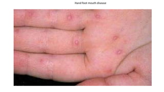 Hand foot mouth disease
 
