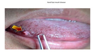 Hand foot mouth disease
 