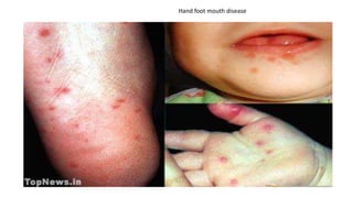 Hand foot mouth disease
 
