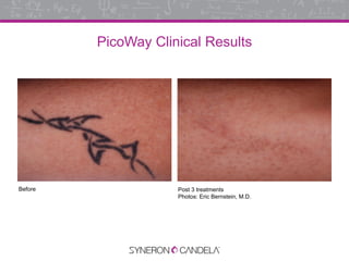 PicoWay Clinical Results
Before Post 3 treatments
Photos: Eric Bernstein, M.D.
 