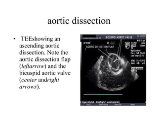 aortic dissection   TEEshowing an ascending aortic dissection. Note the aortic dissection flap ( leftarrow ) and the bicuspid aortic valve ( center  and right arrows ). 