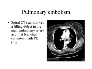 Pulmonary embolism Spiral CT scan showed a filling defect in the main pulmonary artery and first branches consistent with PE (Fig 1  