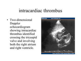 intracardiac thrombus Two-dimensional Doppler echocardiogram showing intracardiac thrombus identified crossing the tricuspid valve and involving both the right atrium and right ventricle.  
