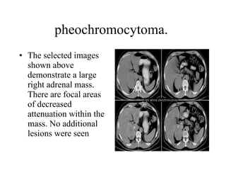 pheochromocytoma.  The selected images shown above demonstrate a large right adrenal mass. There are focal areas of decreased attenuation within the mass. No additional lesions were seen  