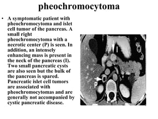 pheochromocytoma A symptomatic patient with pheochromocytoma and islet cell tumor of the pancreas. A small right pheochromocytoma with a necrotic center (P) is seen. In addition, an intensely enhancing mass is present in the neck of the pancreas (I). Two small pancreatic cysts are also seen but the bulk of the pancreas is spared. Pancreatic islet cell tumors are associated with pheochromocytomas and are generally not accompanied by cystic pancreatic disease.   