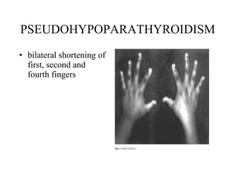 PSEUDOHYPOPARATHYROIDISM bilateral shortening of first, second and fourth fingers  