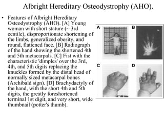 Albright Hereditary Osteodystrophy (AHO). Features of Albright Hereditary Osteodystrophy (AHO). [A] Young woman with short stature (~ 3rd centile), disproportionate shortening of the limbs, generalized obesity, and round, flattened face. [B] Radiograph of the hand showing the shortened 4th and 5th metacarpals. [C] Fist with the characteristic 'dimples' over the 3rd, 4th, and 5th digits replacing the knuckles formed by the distal head of normally sized metacarpal bones (Archibald sign). [D] Brachydactyly of the hand, with the short 4th and 5th digits, the greatly foreshortened terminal 1st digit, and very short, wide thumbnail (potter's thumb).  