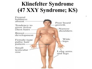 Klinefelter Syndrome (47 XXY Syndrome; KS) 