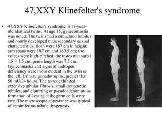 47,XXY Klinefelter's syndrome 47,XXY Klinefelter's syndrome in 17-year-old identical twins. At age 15, gynecomastia was noted. The twins had a eunuchoid habitus and poorly developed male secondary sexual characteristics. Both were 187 cm in height; arm spans were 187 cm and 189.5 cm; the voices were high-pitched; the testes measured 1.8 × 1.5 cm; penis length was 7.5 cm. Gynecomastia and signs of androgen deficiency were more evident in the twin on the left. Urinary gonadotropins, greater than 50 mU/24 hours. The testes exhibited extensive tubular fibrosis, small dysgenetic tubules, and clumping or pseudoadenomatous formation of Leydig cells; germ cells were rare. The microscopic appearance was typical of seminiferous tubule dysgenesis.  