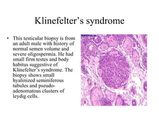 Klinefelter’s syndrome This testicular biopsy is from an adult male with history of normal semen volume and severe oligospermia. He had small firm testes and body habitus suggestive of Klinefelter’s syndrome. The biopsy shows small hyalinized seminiferous tubules and pseudo-adenomatous clusters of leydig cells.  