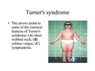 Turner's syndrome The arrows point to some of the classical features of Turner's syndrome: ( A ) short webbed neck; ( B ) cubitus valgus; ( C ) lymphedema.  