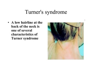 Turner's syndrome A low hairline at the back of the neck is one of several characteristics of Turner syndrome   