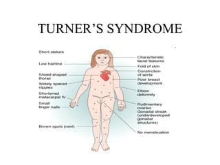 TURNER’S SYNDROME 