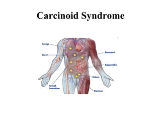 Carcinoid Syndrome 