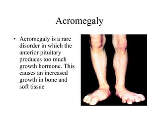 Acromegaly Acromegaly is a rare disorder in which the anterior pituitary produces too much growth hormone. This causes an increased growth in bone and soft tissue  