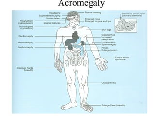 Acromegaly 