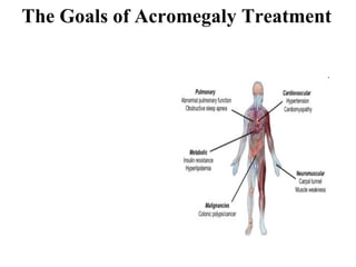 The Goals of Acromegaly Treatment 