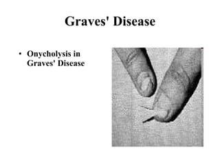 Graves' Disease Onycholysis in Graves' Disease 