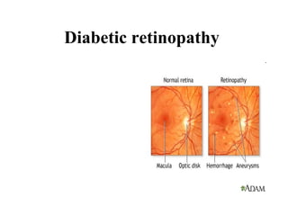 Diabetic retinopathy  