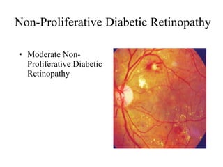 Non-Proliferative Diabetic Retinopathy  Moderate Non-Proliferative Diabetic Retinopathy  