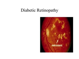 Diabetic Retinopathy 