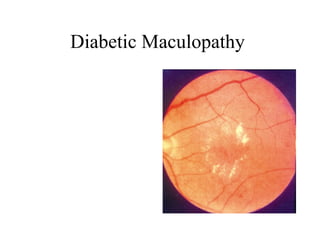 Diabetic Maculopathy  