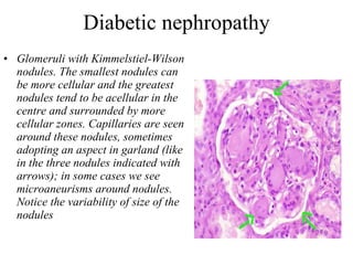 Diabetic nephropathy Glomeruli with Kimmelstiel-Wilson nodules. The smallest nodules can be more cellular and the greatest nodules tend to be acellular in the centre and surrounded by more cellular zones. Capillaries are seen around these nodules, sometimes adopting an aspect in garland (like in the three nodules indicated with arrows); in some cases we see microaneurisms around nodules. Notice the variability of size of the nodules  